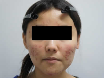 22歳 女性：難治性ニキビにロアキュタン治療　術前