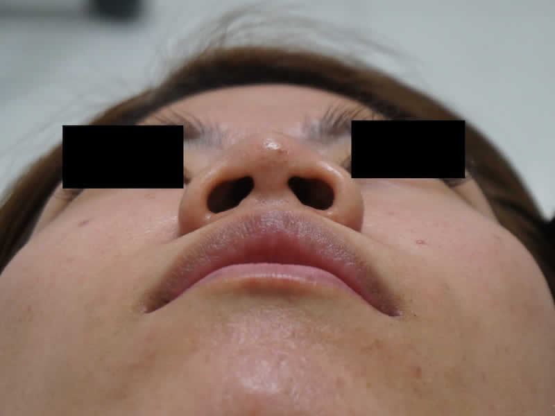 小鼻の縮小（鼻翼縮小術）＋他院修正　術前