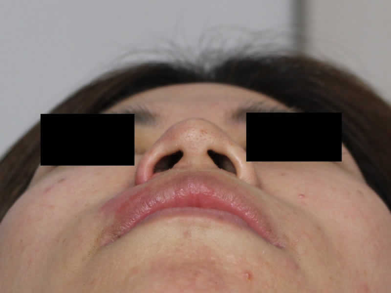 小鼻の縮小（鼻翼縮小術）＋他院修正　術後1年8か月