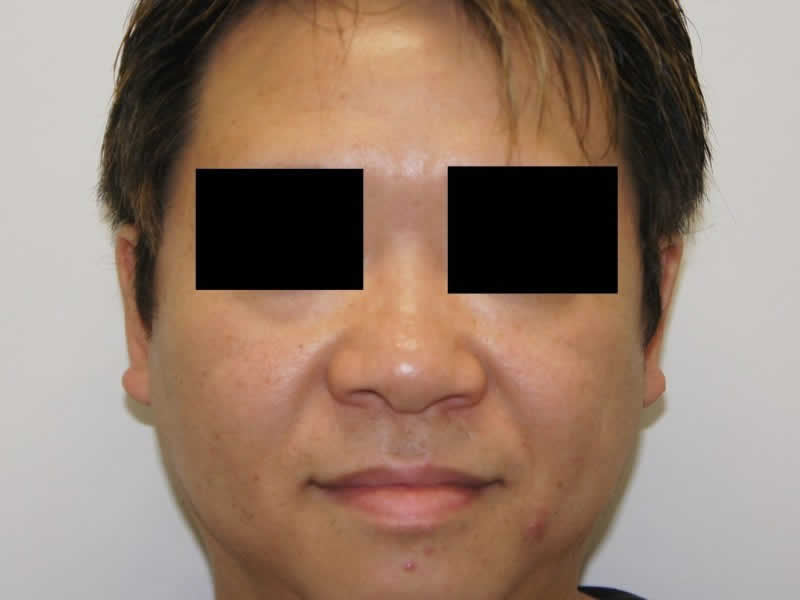 小鼻縮小術＋鼻プロテーゼ＋鼻尖修正　術前