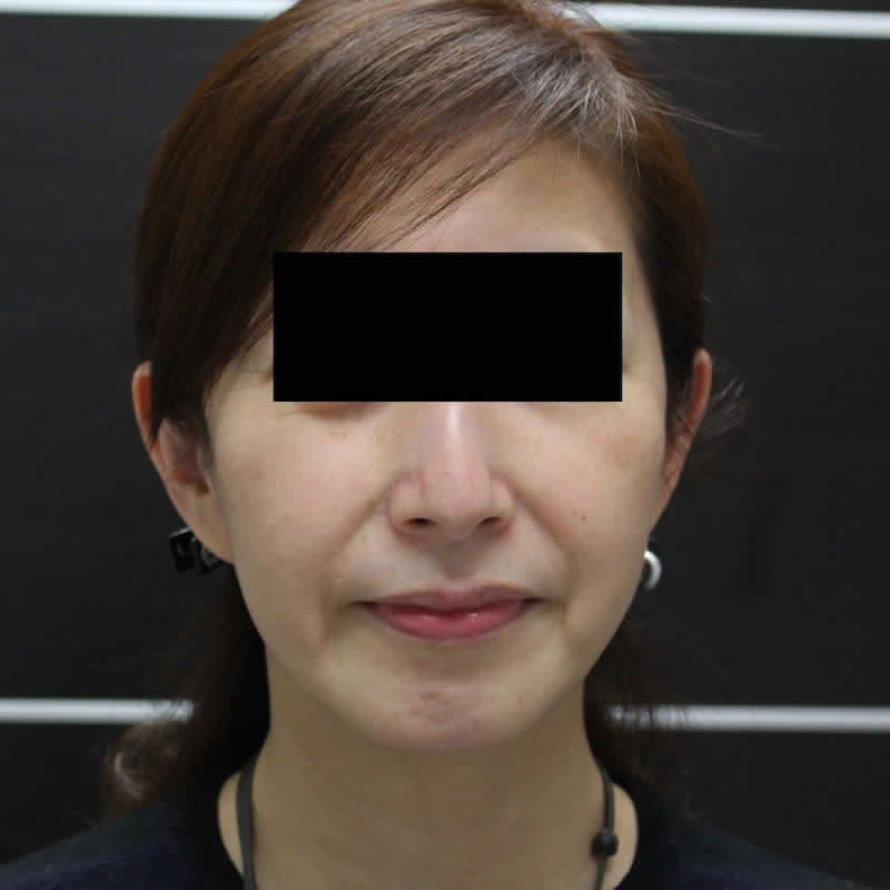 女性 45歳：サーマクールFLX（静脈麻酔） 術後2か月