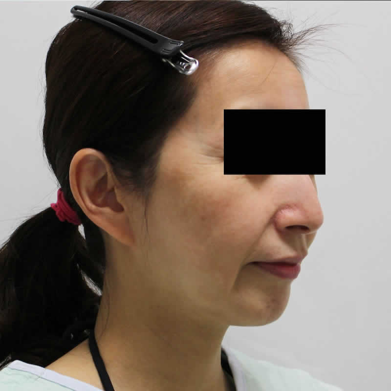 女性 45歳：サーマクールFLX（静脈麻酔） 術前