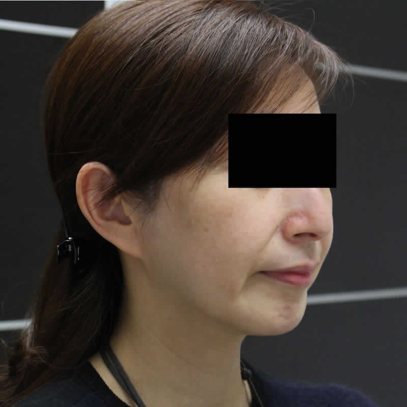 女性 45歳：サーマクールFLX（静脈麻酔） 術後2か月