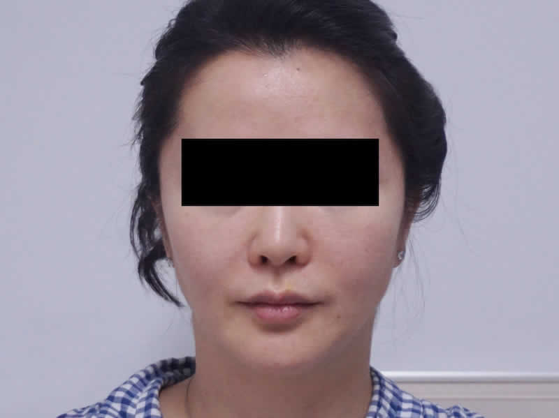 39歳 女性：ウルセラ（静脈麻酔で最高出力）　術後2か月