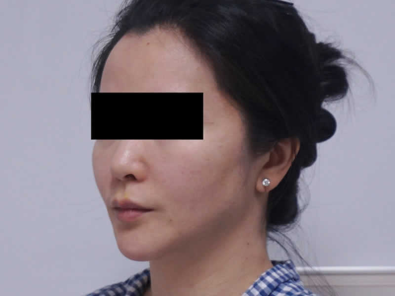 39歳 女性：ウルセラ（静脈麻酔で最高出力）　術後2か月