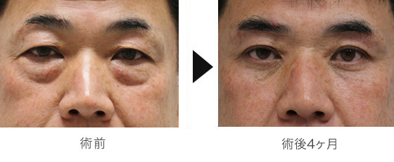 症例：経結膜脱脂術+マイクロコンデンスリッチファット（眼の下・中顔面）