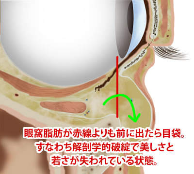 眼窩脂肪が赤線よりも前に出たら目袋。