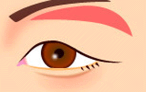 上まぶたのたるみ取り