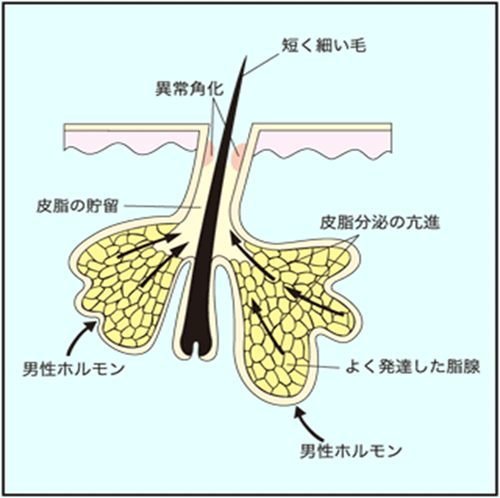 ニキビの原因
