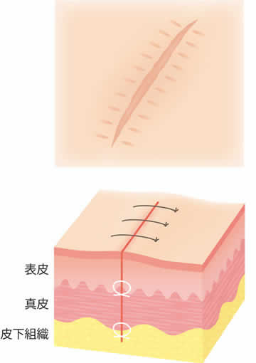 真皮縫合・減張縫合