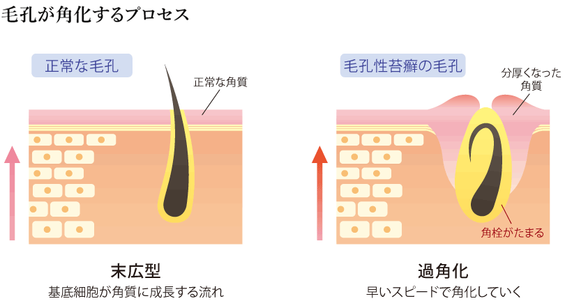 毛孔が角化するプロセス
