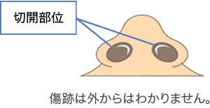 鼻尖修正