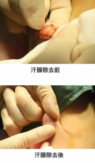 汗腺除去前後