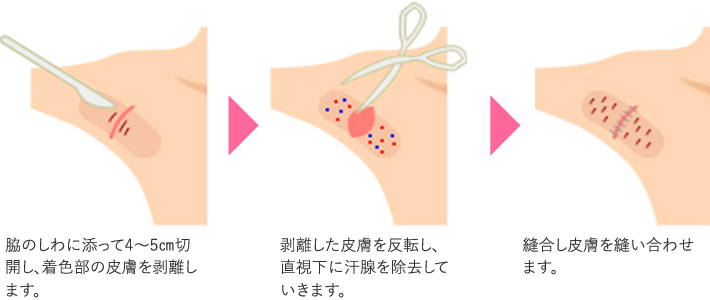 皮弁法(剪除法)の治療方法