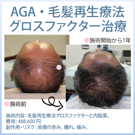 薄毛改善 毛髪再生治療【AGA・FAGA】