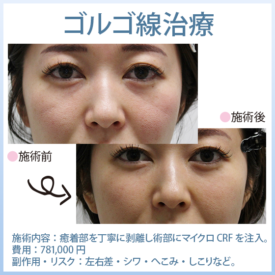 ゴルゴ線（ゴルゴライン、インディアンライン）治療【ゴルゴ線剥離・脂肪注入・マイクロCRF】