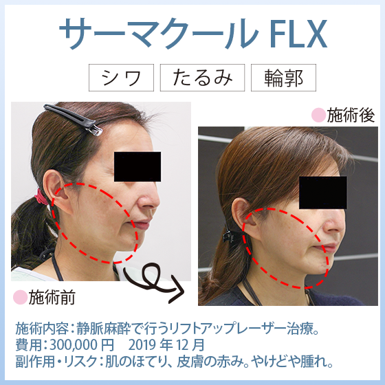 サーマクールFLX
