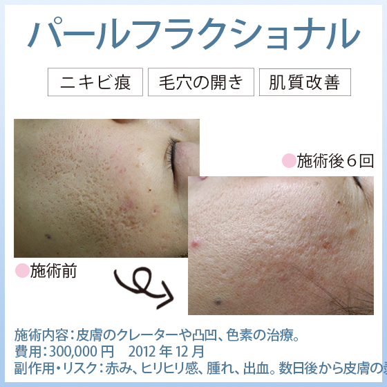 ニキビ痕治療 パールフラクショナル