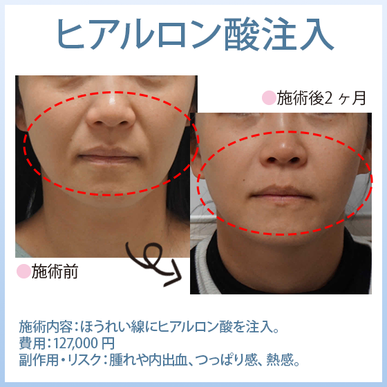 ヒアルロン酸注入