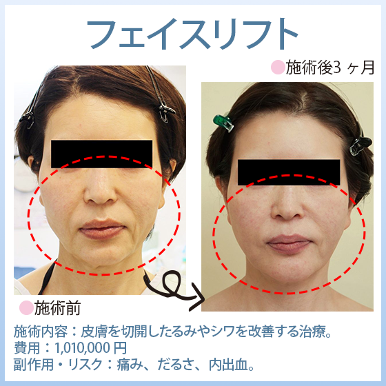 フェイスリフト