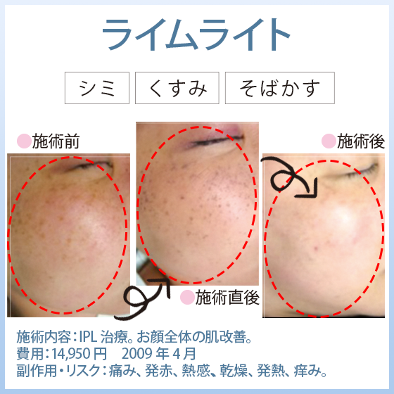 ライムライト（IPL：光治療）