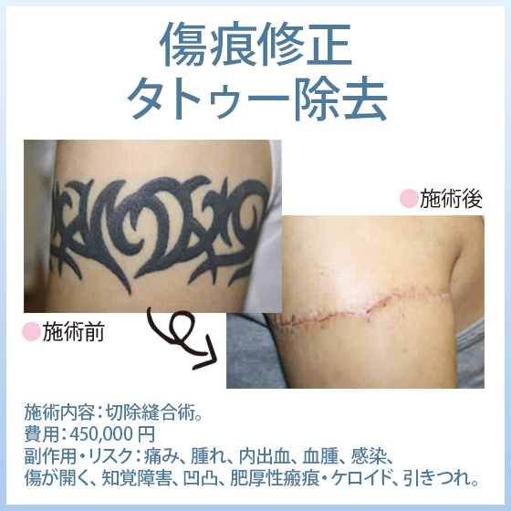 傷痕・刺青・タトゥー除去