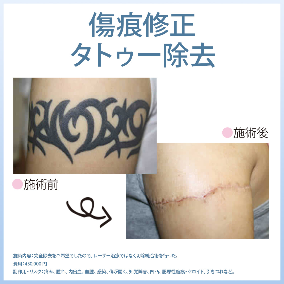 傷痕・刺青・タトゥー除去