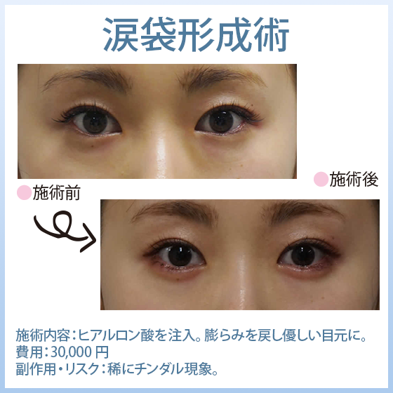 涙袋形成術