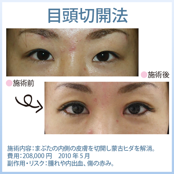 目頭切開法