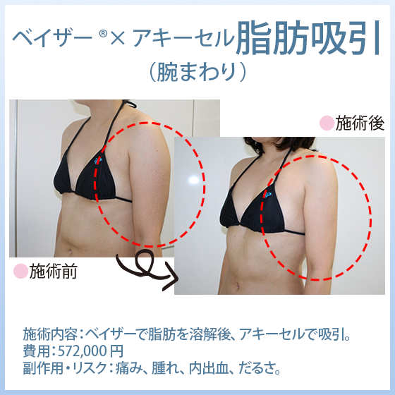「ベイザー®脂肪吸引×アキーセル脂肪吸引」 二の腕・腕まわりの脂肪吸引