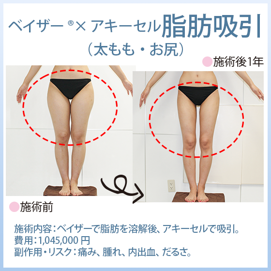 「ベイザー®脂肪吸引×アキーセル脂肪吸引」 太もも・お尻の脂肪吸引