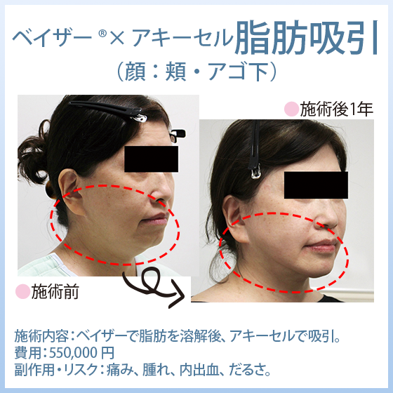 「ベイザー®脂肪吸引×アキーセル脂肪吸引」 顔の脂肪吸引
