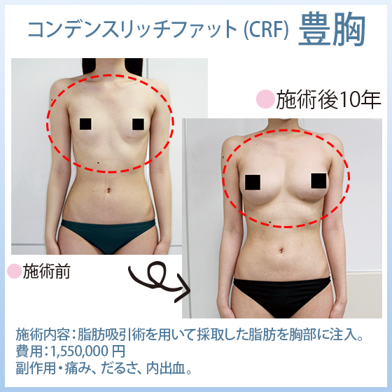 豊胸・バスト整形