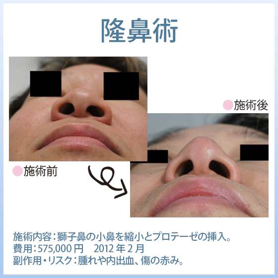 鼻形成術【プロテーゼ・ヒアルロン酸隆鼻術、鼻尖修正、小鼻縮小、小鼻のボトックス】