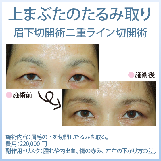 上まぶたのたるみ取り（眉下切開術・二重ライン切開術）