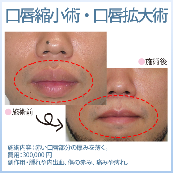 口唇縮小術