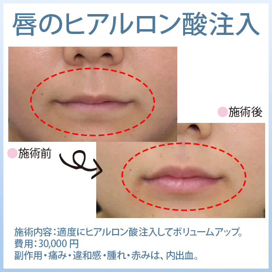唇のヒアルロン酸注入