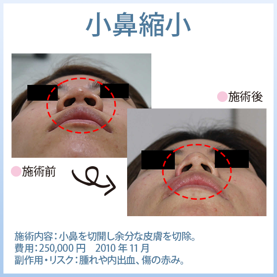 小鼻縮小
