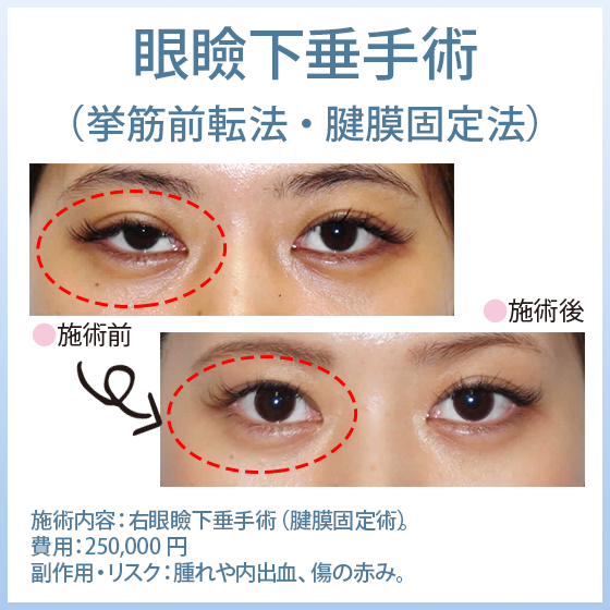 眼瞼下垂症手術（挙筋前転法、腱膜固定法）