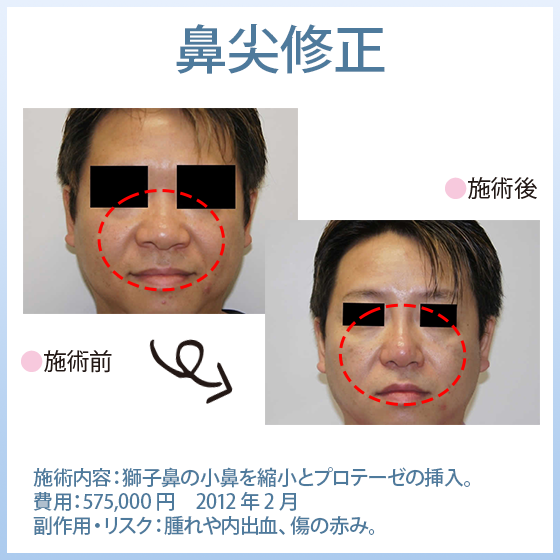 鼻尖修正
