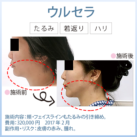 ウルセラ