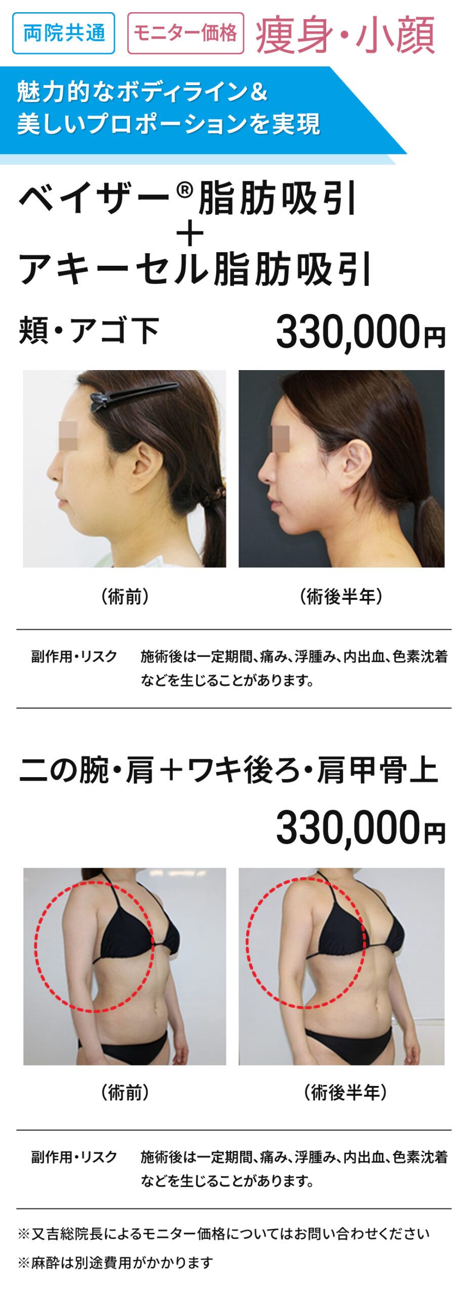 両院共通　ベイザー＋アキーセル脂肪吸引　モニター