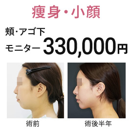 痩身・小顔　脂肪吸引　モニター