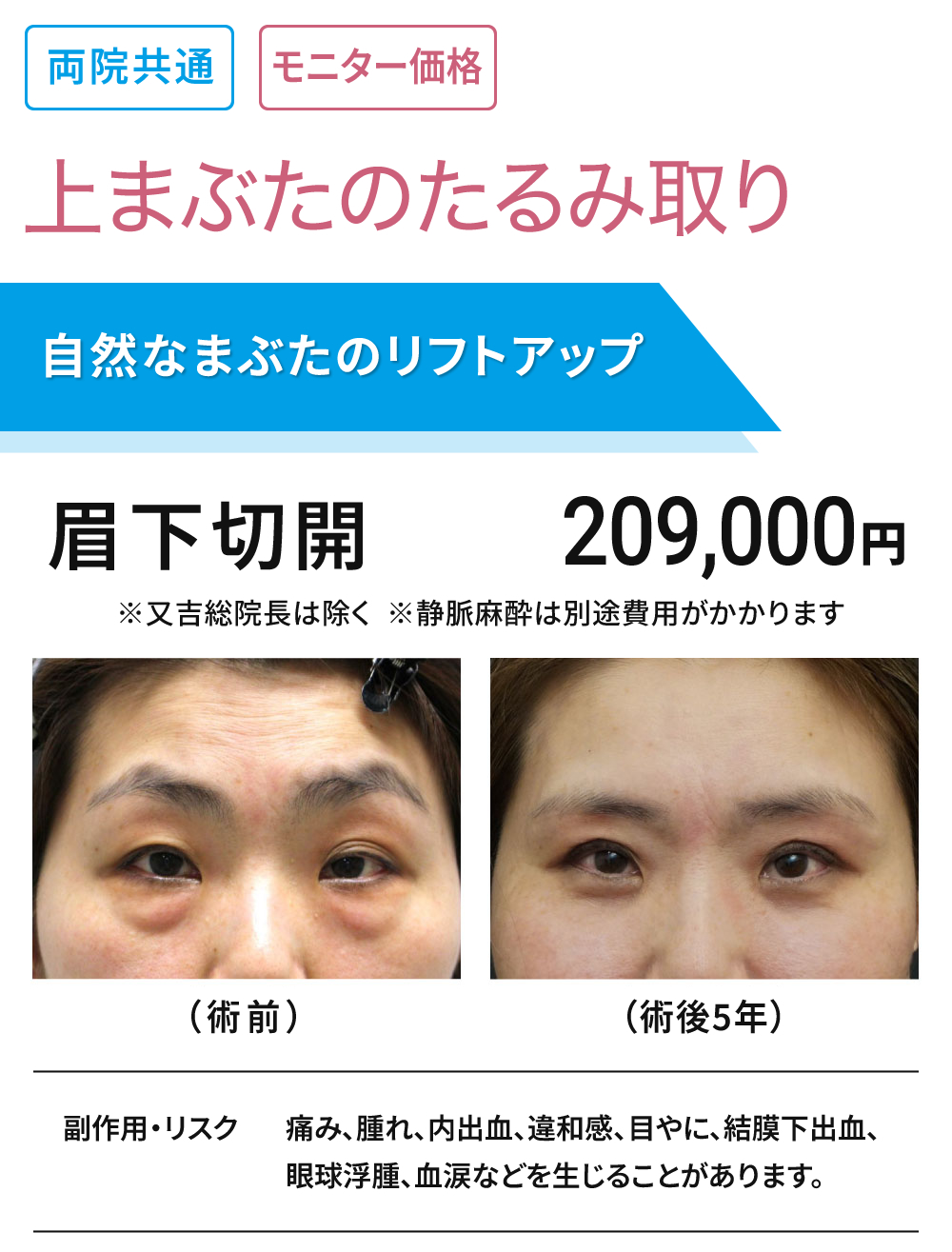 両院共通　上まぶたのたるみ取り　モニター