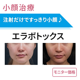 小顔治療　エラボトックス100単位　モニター