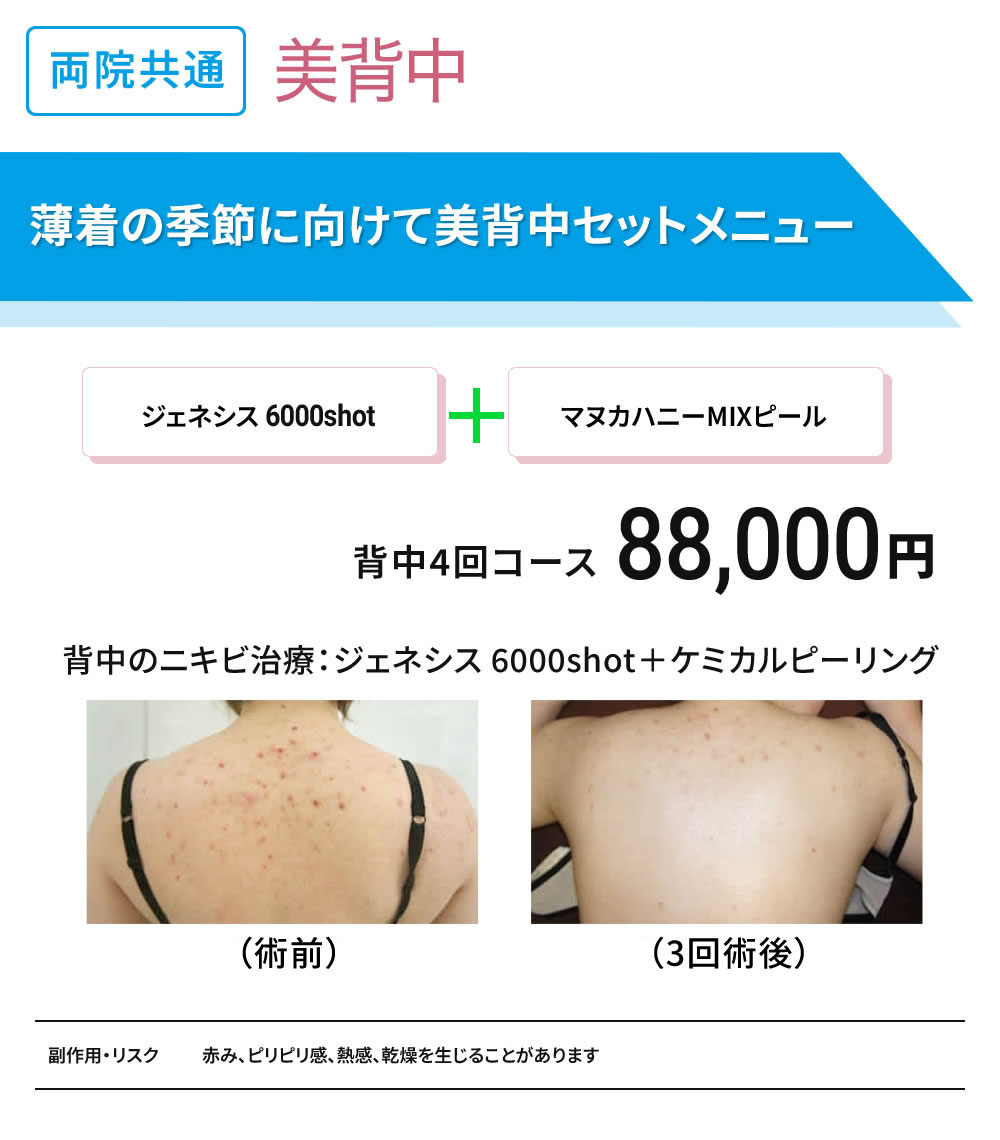 美背中セット治療　背中のニキビ、ニキビ痕治療4回コース