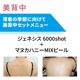 美背中セット治療　4回コース