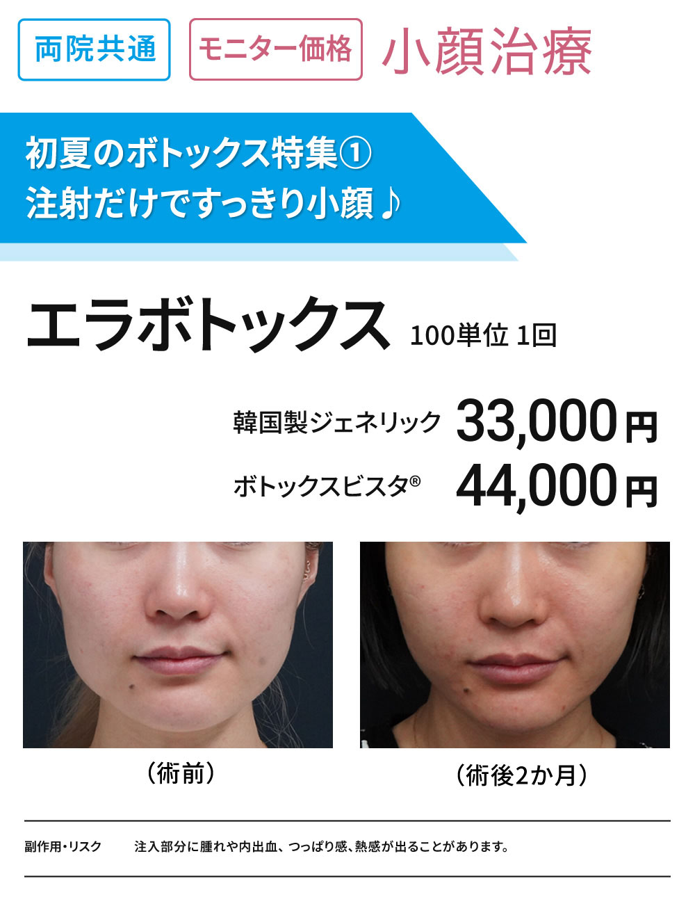 初夏のボトックス特集①　小顔治療　エラボトックス100単位　モニター