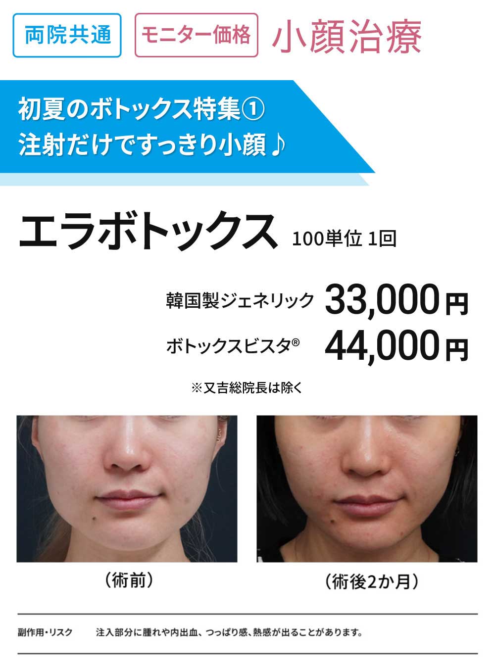初夏のボトックス特集①　小顔治療　エラボトックス100単位　モニター