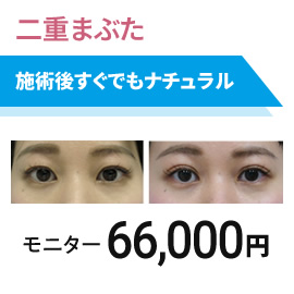 二重埋没法　モニター